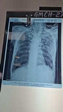 CXR Pneumothorax | Visceral Pleura | Absent Lung markings | Black area is air | Deep sulcus sign