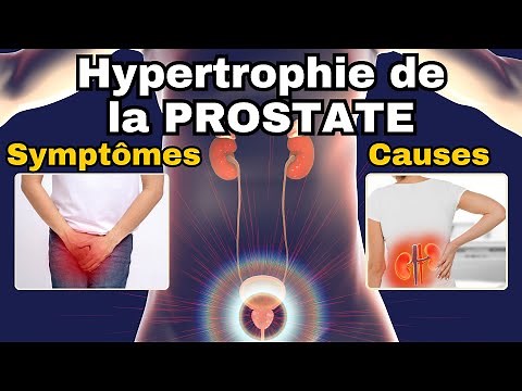 Most common symptoms of benign prostatic hyperplasia (BPH)