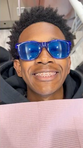 Before and After Braces OFF! 🔥