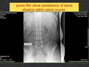 CASE 64 IVP Delayed faint persistent left nephrogram Dr AHMED ESAWY
