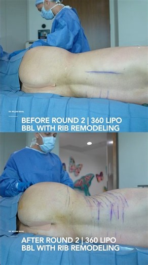 360 lips & BBL with Rib Remodeling #ribremodeling #genderaffirmingsurgery #liposuction #bbl #lipo