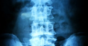 Spine Tumor Facts