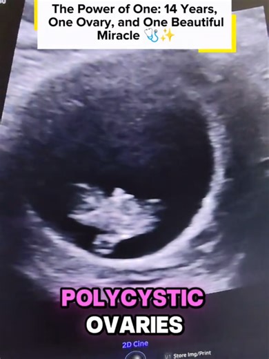 The Power of One: 14 Years, One Ovary, and One Beautiful Miracle 🩺✨ At 37, this patient is embarking on her first pregnancy. Her journey didn't start today; it started 14 years ago when she underwent a left oophorectomy (removal of the left ovary). On top of that, she manages Polycystic Ovaries (PCO), a condition that often brings concerns about ovulation and fertility. If you’ve successfully navigated pregnancy with one ovary or managed PCO in your late 30s, please drop a
