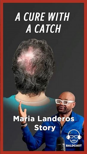 Folliculitis Decalvans: Disease Gone but Hair Missing | BaldCast Chapter 19