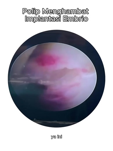 Polip Rahim: Pengaruhnya pada Kehamilan dan Solusi Histeroskopi