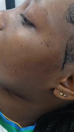 Book Your Wart Removal Appointment in Maypen!