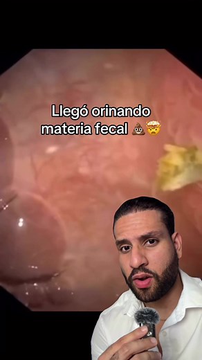 Fístula Colovesical: Orinando Heces por la Vejiga