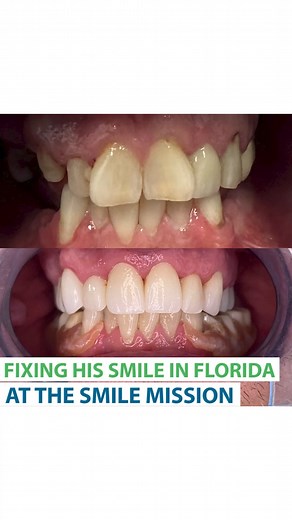 The Smile Mission Lakeland on Instagram: "🇺🇸 Fixing his smile in Florida at The Smile Mission 🙌 At The Smile Mission we thrive to give you the best smile. We will take care of your oral health with our professional team to complete your smile! 😁 ✅ Free consultation ✅ The most affordable prices ✅ 10/10 Quality Our clients are happy with our service, so what are you waiting for? 😉 ▶️ Invest in your smile because you are going to be wearing it everyday! 🇪🇸 En The Smile Mission nos esforzamos