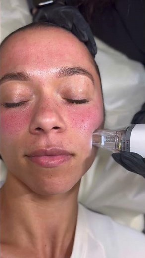 Potenza RF Microneedling at SEV Laser