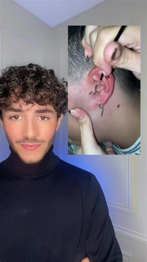 Extraction de points noirs : conseils et vidéos satisfaisantes