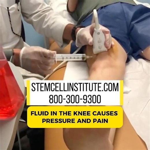 Knee Fluid Drainage Isn’t Enough — Use Stem Cells and PRP #KneePain #JointHealth #RegenerativeCare