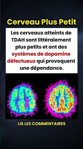 Comment le TDAH affecte-t-il réellement le cerveau ? 🧠
