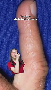 6.6K views · 60 reactions | A skin condition characterized by small blisters on the palms of hands, soles of the feet and edges of the fingers and toes. #dermatology #skincare #kashperience #skincaretips #skincareroutine | Dr. Kash Dermatology | Facebook