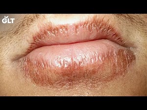 Say Goodbye to Chapped Lips Forever with These 4 Simple Remedies