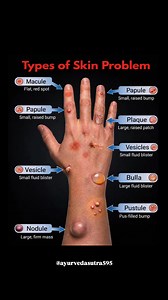 Different skin problems have different signs — macule, papule, vesicle, bulla, pustule, plaque, and nodule. 👩‍⚕️🧴 Knowing the type is the first step toward the right treatment. If you notice unusual changes, don’t ignore your skin—early care matters! #SkinHealth #SkinProblems #Dermatology #HealthySkin #SkinCareAwareness #MedicalKnowledge #SkinConditions #KnowYourSkin #HealthEducation | Ayurveda Sutra