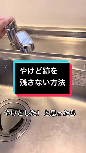 やけど対処法：傷跡を消すコツと注意点