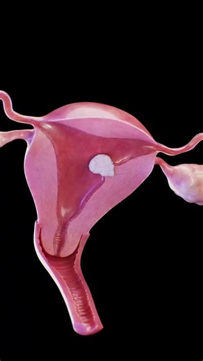 Bio_medicine | A submucosal pedunculated fibroid is a type of uterine fibroid that grows into the uterine cavity — attached to the uterine wall by a thin... | Instagram