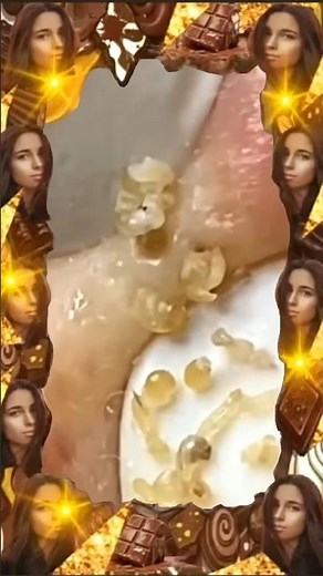 Blackheads Removal | Acne Treatment and Very Satisfying Satisfying Pimple pop #blackheads