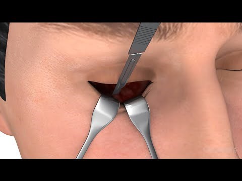 Eye Fracture Surgery - 3D medical animation
