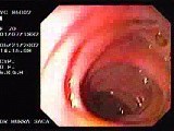 Erythematous Colon Mucosa (1 of 3) • Video • MEDtube.net