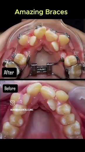 How Orthodontic Braces Work Video - Dr. Sinha Dental Clinic