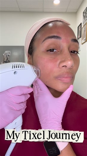 SkynBar | Atlanta Skin Studio | I finally treated myself to a Tixel® session and documented the full 7-day journey so you can see exactly what the healing process looks... | Instagram