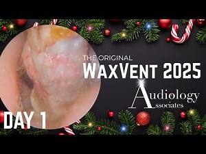 25-Minute Keratosis Obturans Extraction - Waxvent Day 1