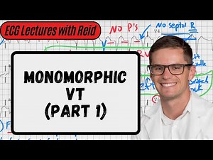 Monomorphic Ventricular Tachycardia | Day 21 ECG Challenge
