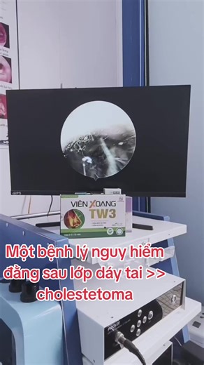 Một bệnh lý nguy hiểm đằng sau lớp dáy tai >>> cholestetoma#thịnhhành #xuhướng #tiktok #nêubật #thinhhanhtiktok @BS Trần Long CK1 TMH @BS Trần Long CK1 TMH