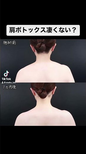 【ビフォーアフター】肩ボトックスの効果が凄すぎる… #shorts #美容整形 #肩こり