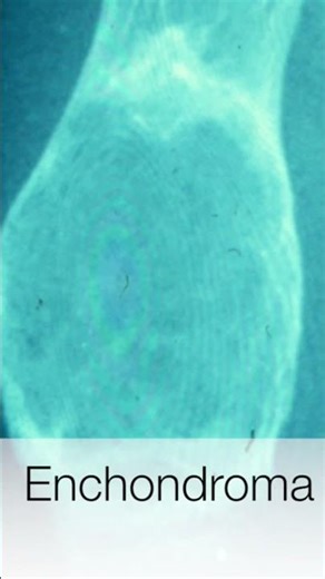 Enchondroma - Pathology #shorts