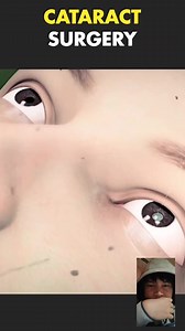 78K views · 941 reactions | Cataract Surgery | Jengle Maravilla Sabado | Facebook