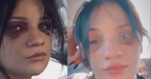 La verdadera historia de Haley Grace Phillips, la mujer con “ojos de panda” que impactó con su triste mirada