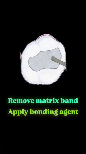 Class II Composite Restoration – Step by Step 🦷| Dr.Dentique-hub