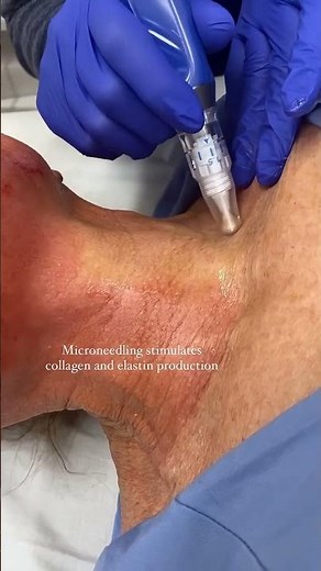 Microneedling + PRP: The Med Spa Duo ⚡