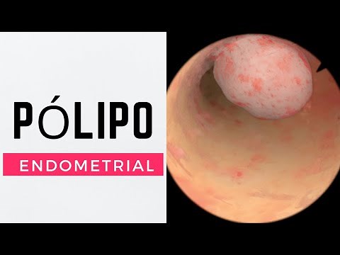 How is an endometrial polyp treated?