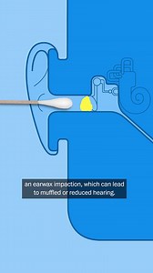 Here’s what can happen if you clean your ears with a cotton swab