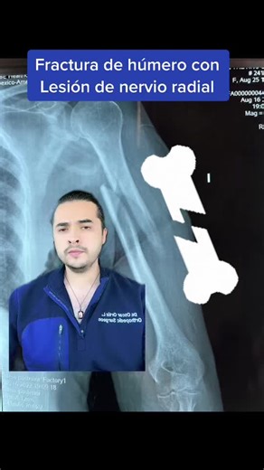 Fractura de húmero con lesión nerviosa: Recuperación y tratamiento