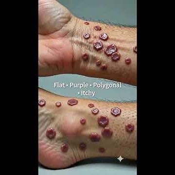 Lichen planus what you should know......