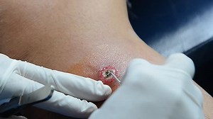 Nurse open abscess by needle.