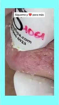 Ear cyst 👀