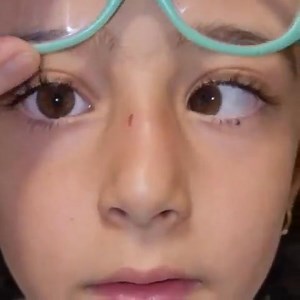 🔵 Esotropia is divided into accommodative and non- accommodative. The accommodative esotropia is a convergent deviation of the eye associated with activation of the accommodation reflex. Accommodative esotropia is divided into refractive and non- refractive. The accommodative refractive esotropia is divided into two parts, namely fully and partially. A fully accommodative esotropia is a specific type of intermittent squint where one or both eyes can turn inwards (convergent). Refractive accommo