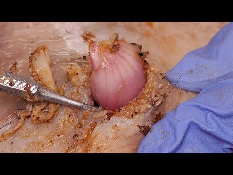 [ASMR] New #采耳哥 | Booger swax removal | Booger clean |Giant Boogerswax #Satisfying 120913