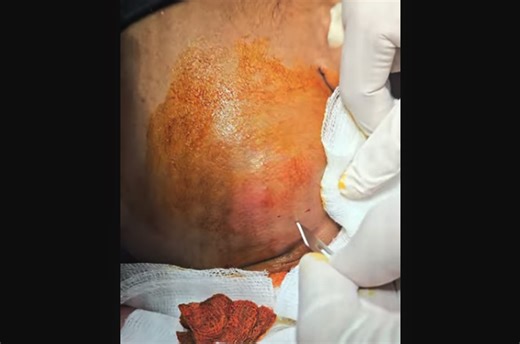Neck Abscess Incision and Drainage