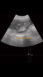 7.6K views · 27 reactions | Prenatal check ups - one is at first trimester and the other at the second trimester. May isang non-chalant at may isang super kulit.  Both VBAC Candidates #BabyScans #TOLACCandidates #AbanganAngOutcomes | Doc Ces Estera - OB GYN | Facebook