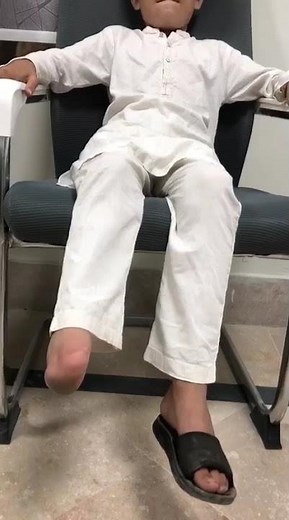 Partial Foot Prosthesis – Life-Changing Mobility Solution