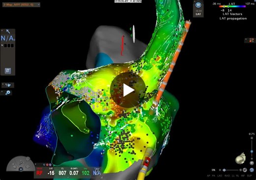 #electrophysiology #cardiology #epeeps #mapping #ablation #optrell | Otakar Jiravský