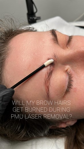 During the safe PMU removal procedure the laser removes pigment, not hairs. The procedure is not burning your brows or skin. If you have old discolourated pmu/microblading book your free removal consultation or dm me to learn more about the procedure and cost. ____________________________________ 𝐀𝐆𝐀𝐓𝐀 𝐖𝐈𝐋𝐊 𝐏𝐌𝐔 & 𝐁𝐑𝐎𝐖 𝐒𝐓𝐔𝐃𝐈𝐎 𝘉𝘢𝘵𝘩 𝘢𝘯𝘥 𝘉𝘳𝘪𝘴𝘵𝘰𝘭 𝘭𝘰𝘤𝘢𝘵𝘪𝘰𝘯 @𝐚𝐠𝐚𝐭𝐚𝐰𝐢𝐥𝐤.𝐩𝐦𝐮 www.agatawilk.com | Agata Wilk PMU
