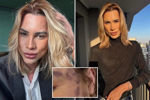 Fashion influencer dead after complaining about complications from ‘fox eyes’ surgery