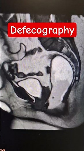 MRI Defecography #medicalimaging #shorts